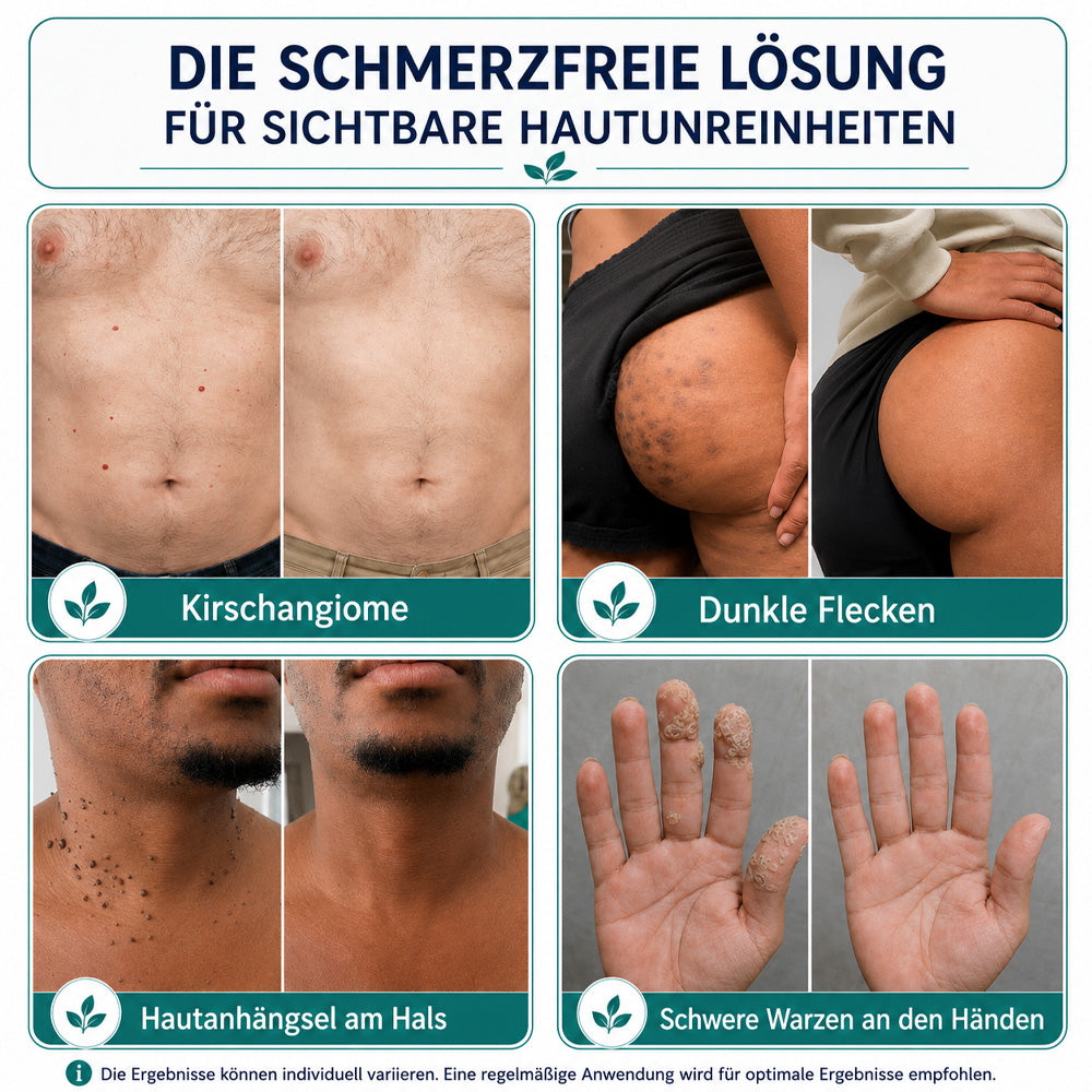 🩵Effektive botanische Mikronadel-Pflaster zur Entfernung von Hautanhängseln